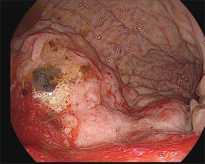 Gastric Adenocarcinoma: A Multimodal Approach